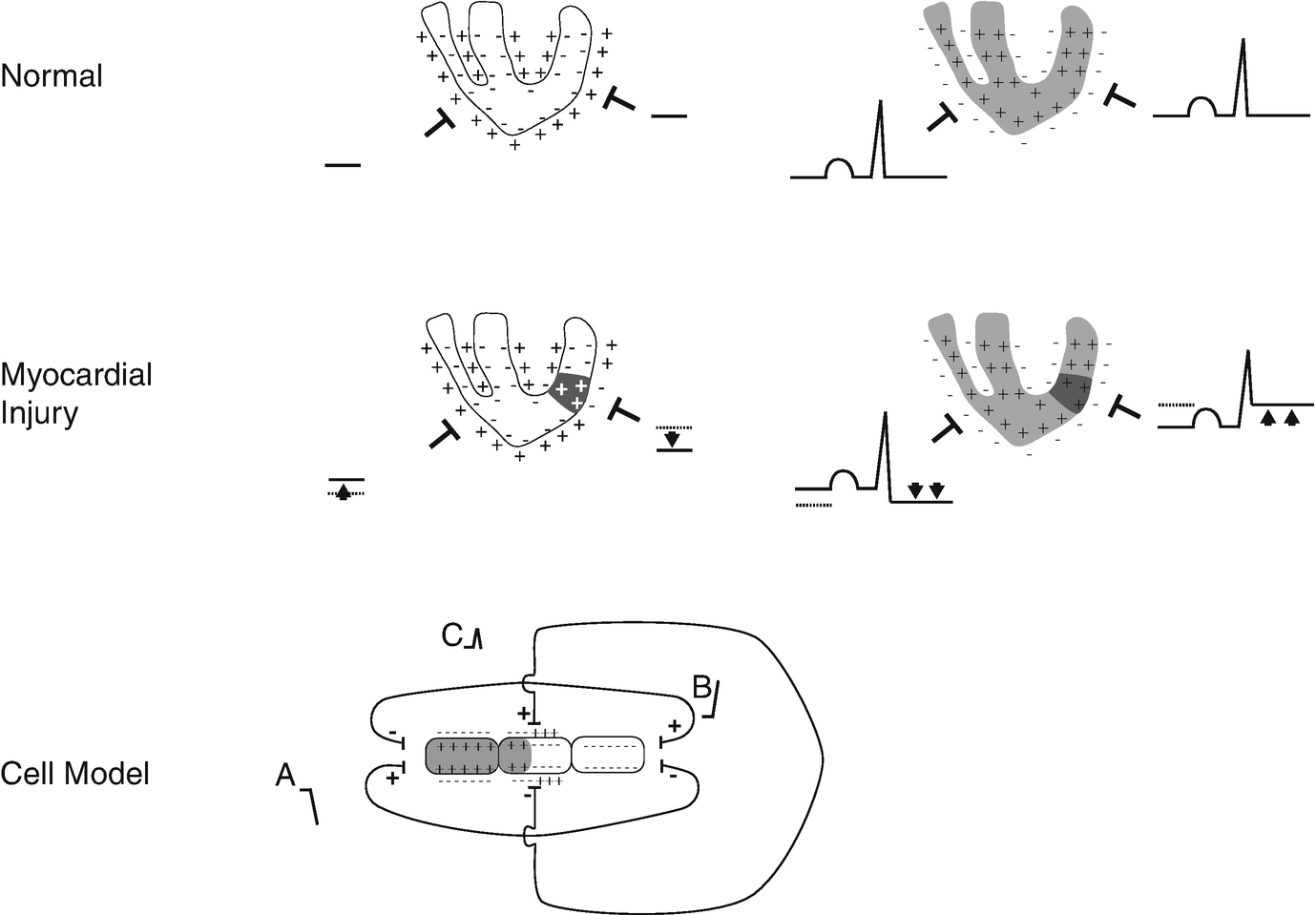 Segmen St EKG Part 7 : Elevasi Segmen ST dan Penemuan Lain pada Infark Miokard ...